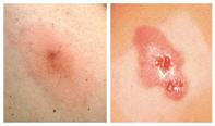 msra-infection